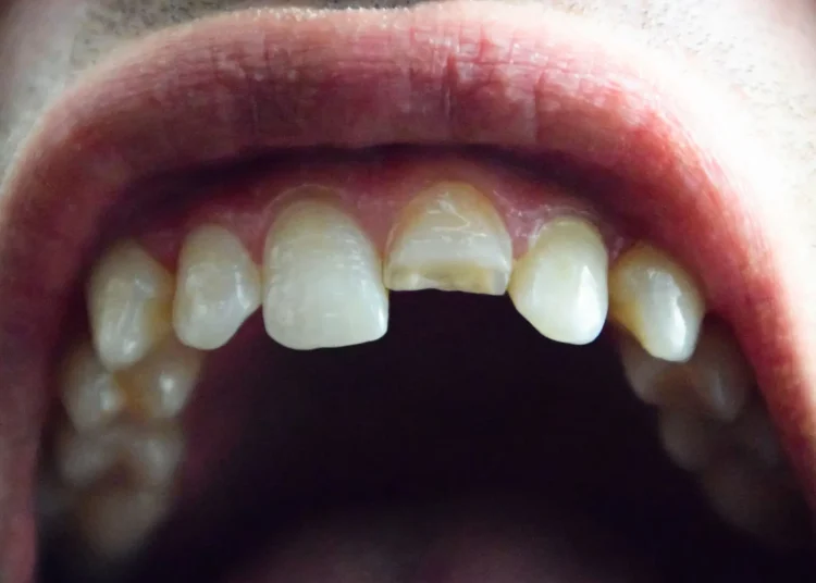 Rüyada diş dökülmesi ne anlama gelir? 2023 - Yorumla.Net